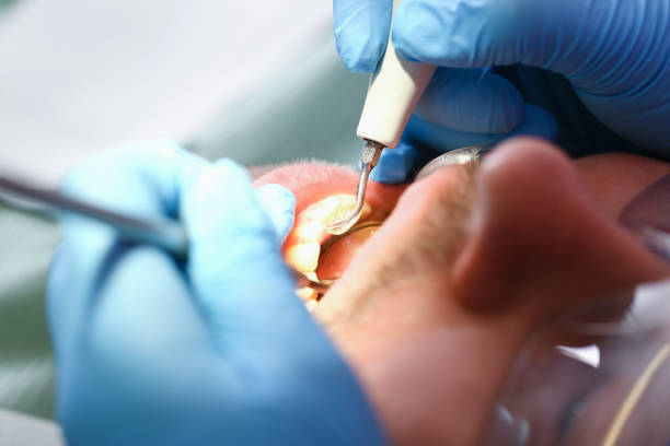 Best Chipped Tooth Repair Near Me  in Glen Burnie, MD